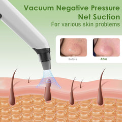 Xamoca blackhead removal tools set featuring stainless steel tools for comprehensive pore care.