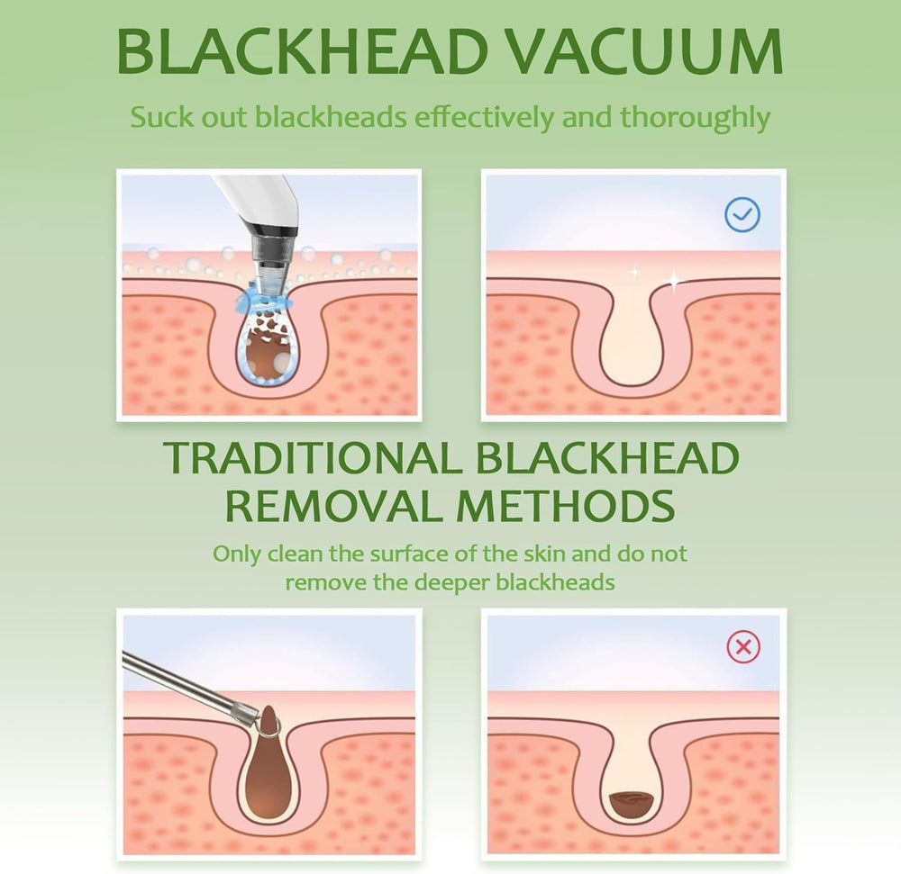 Xamoca blackhead remover vacuum travel case emphasizes on-the-go skincare.
