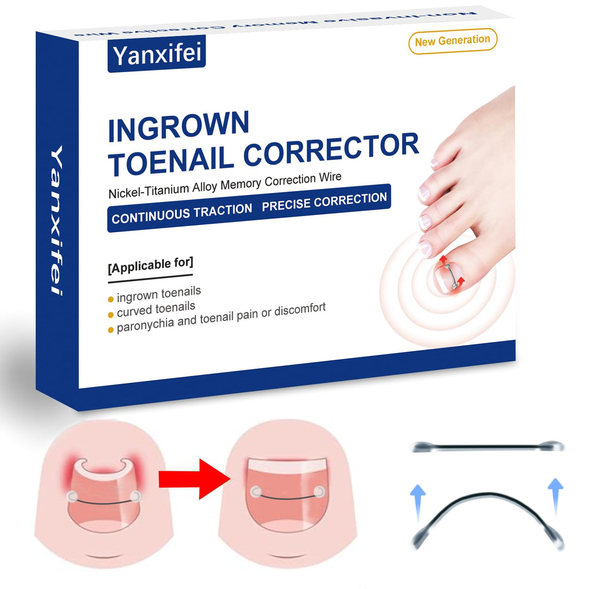 Yanxifei Nitinol ingrown toenail corrector kit — at-home treatment setup for potential relief.