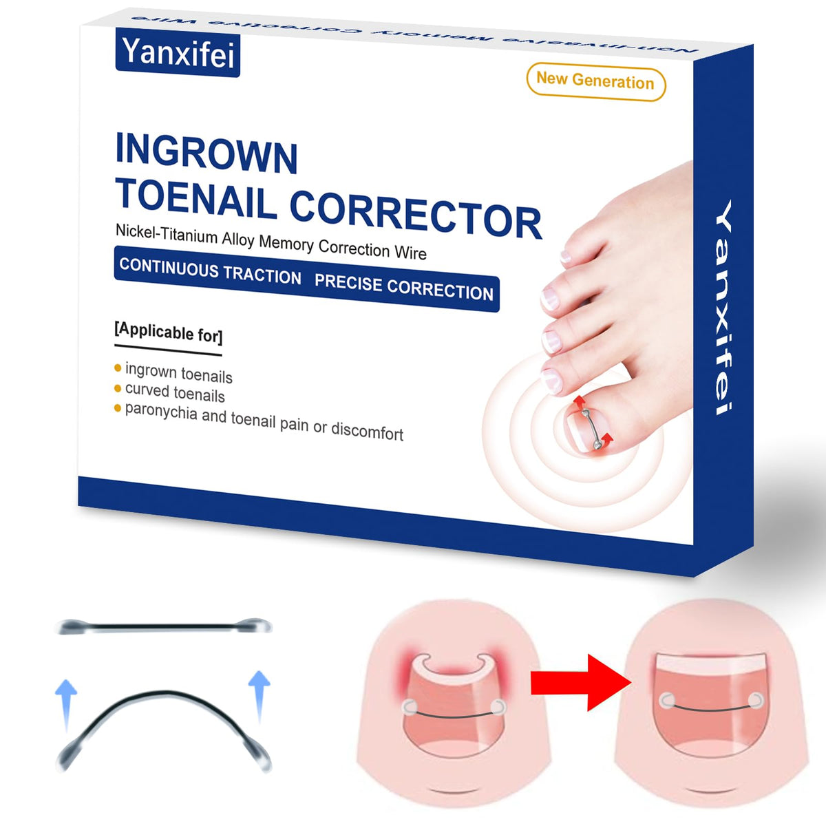 Yanxifei nitinol ingrown toenail corrector on toe promotes lift and targeted relief.