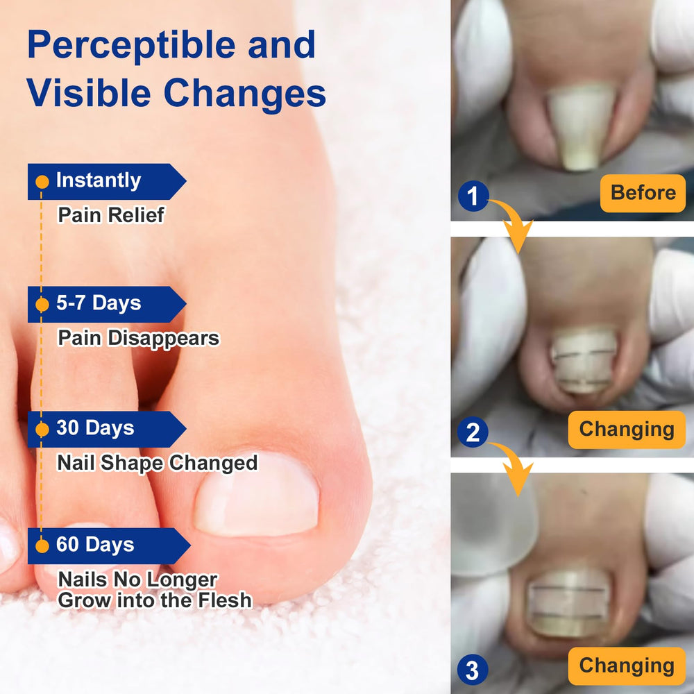 Yanxifei nickel-titanium memory wire corrector — lifts the nail away from the skin, potentially reducing discomfort.