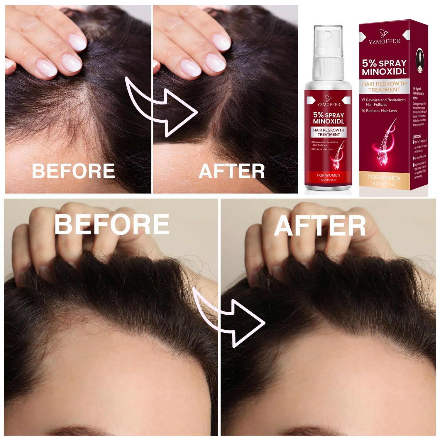 Yzmoffer scalp nourishing minoxidil therapy supporting scalp health
