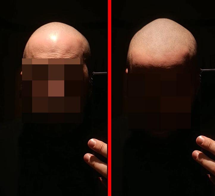 Zero Shine SMP Matte 2.0 matte finish visible on scalp.
