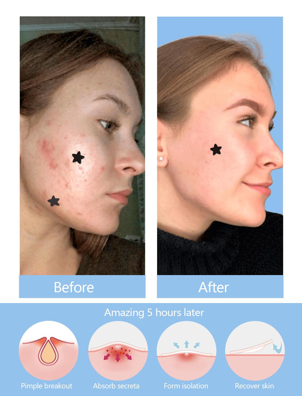 ZHAOLIESM salicylic acid ingredient panel signals targeted blemish support