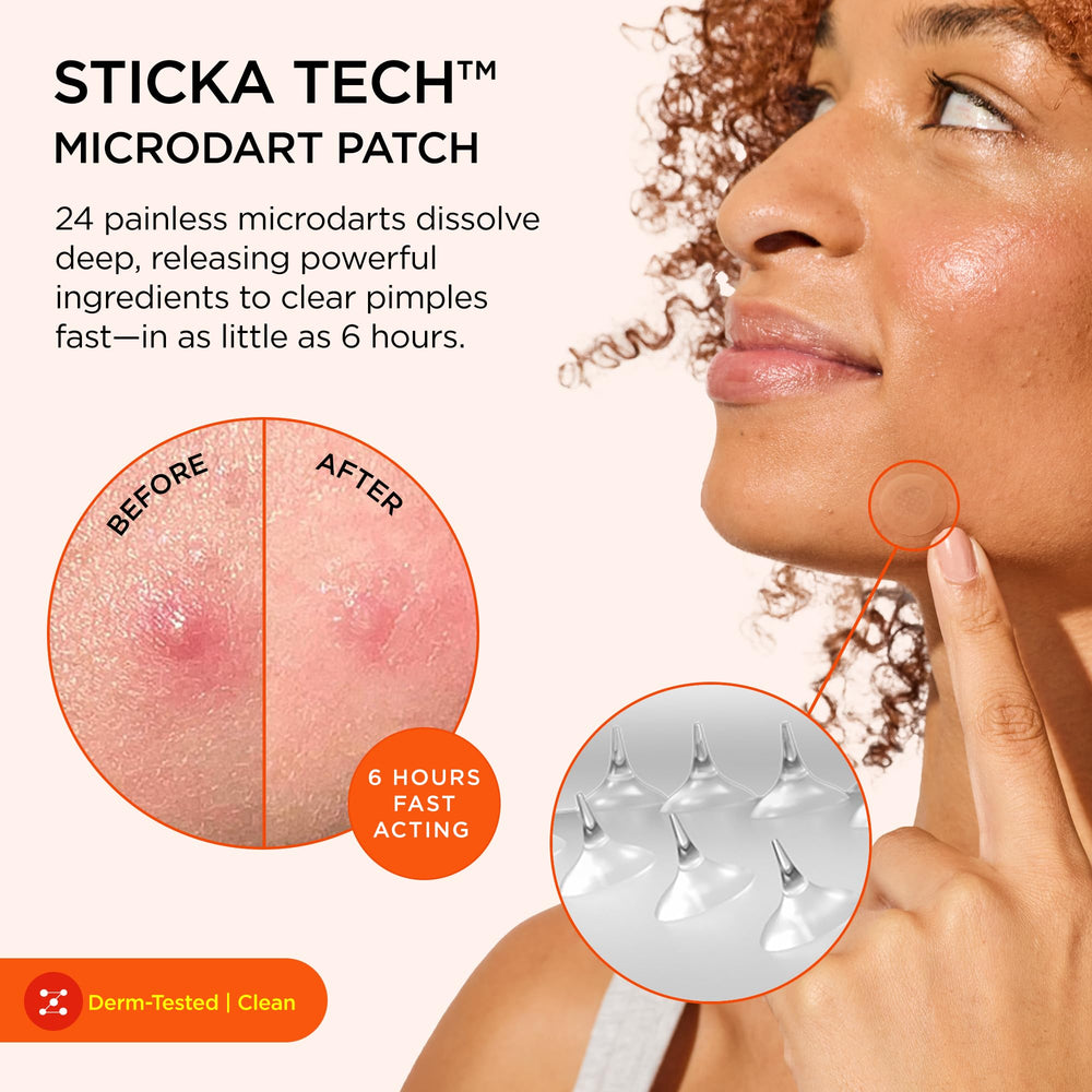 ZitSticka Killa microdarts close-up dissolving to deliver actives for early zits.