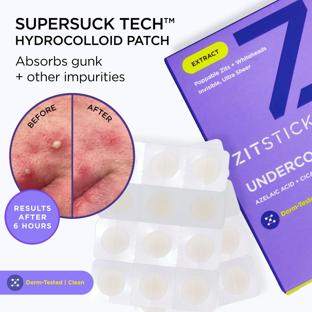 ZitSticka skin blemish extraction close-up shows surface blemish care